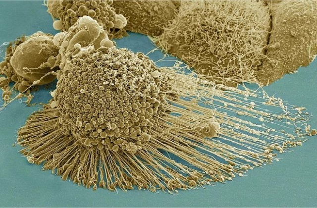 Kanserli Hücreler Tamamen Yok Edilebilecek