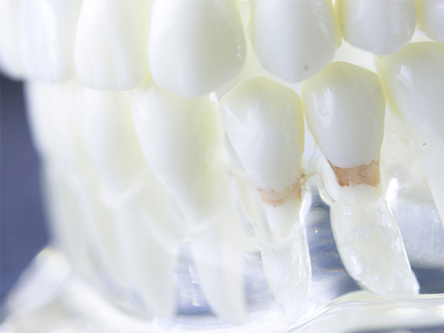 Dental Plak Asitliğini Ölçen Optik Prob