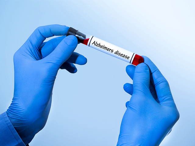 FDA Alzheimer Hastalığı Teşhisi için İlk Kan Testini Onayladı