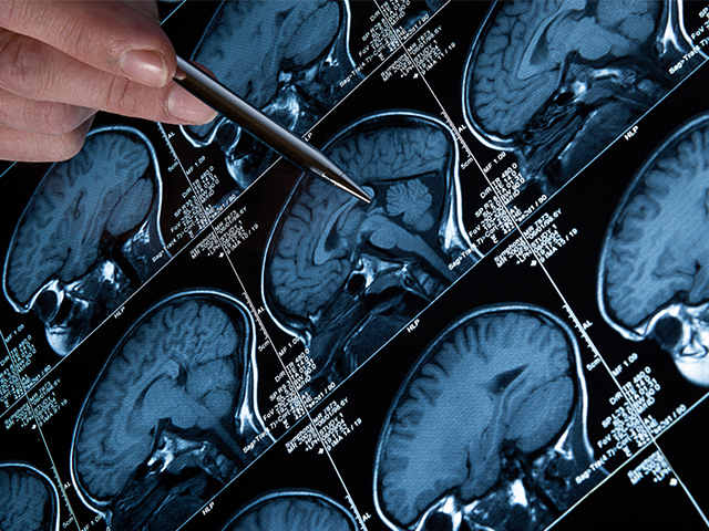 MRI Beyin Taramalarını Geliştiren Kask