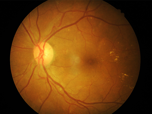 Retina Hastalıklarını İncelemek İçin Biobaskıyla Üretilmiş Göz Dokusu
