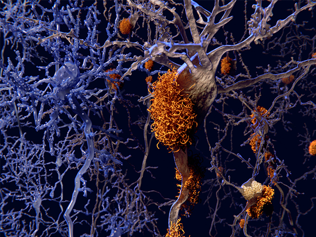 Bilim İnsanları Alzheimer Hastalığı Esnasında Beyin Hücrelerinin Ölümünü Açıkladı