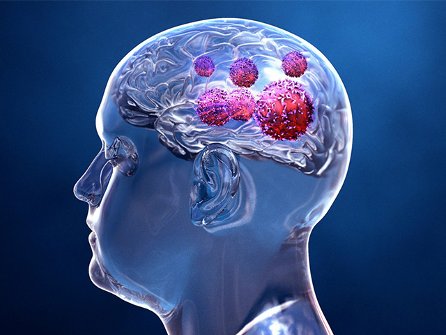 Beyin Tümörü Bulgusunu Kullanarak İlaç İçeren Nanoparça Üretmek