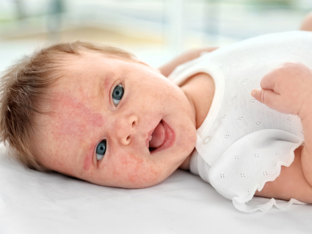 Bebeklerde Egzama Gelişimini Öngören Biyobelirteç Testi 