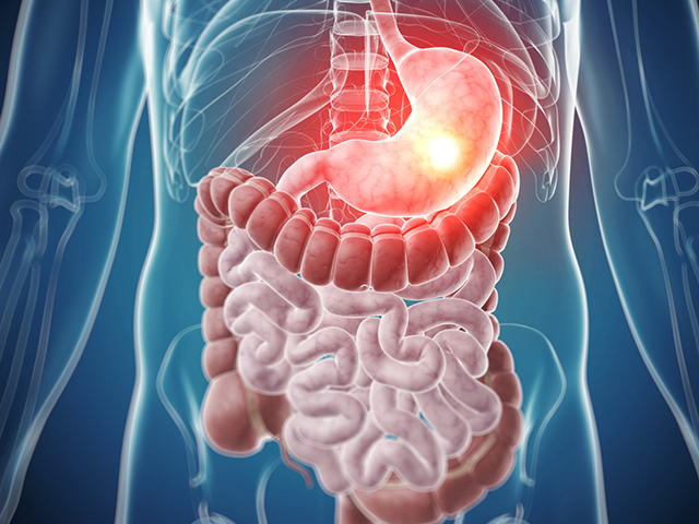 Gastroözofageal Kanser için Önerilen Yeni Tedavi