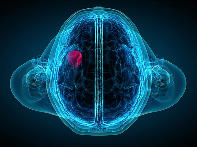 Ölümcül Beyin Tümörünü Ortadan Kaldırabilen Kombinatoryal Glioblastoma Tedavisi